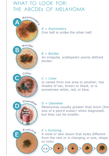 What to Look For: The ABCDE's of Melanoma