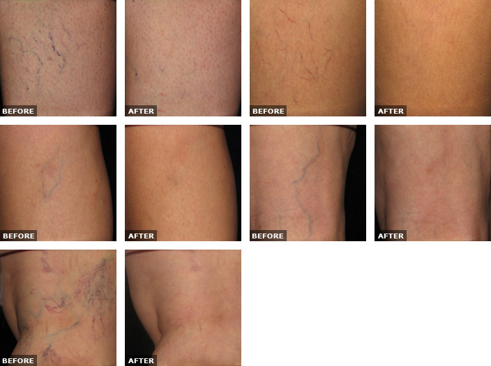 Sclerotherapy New Orleans, LA New Orleans Sclerotherapy