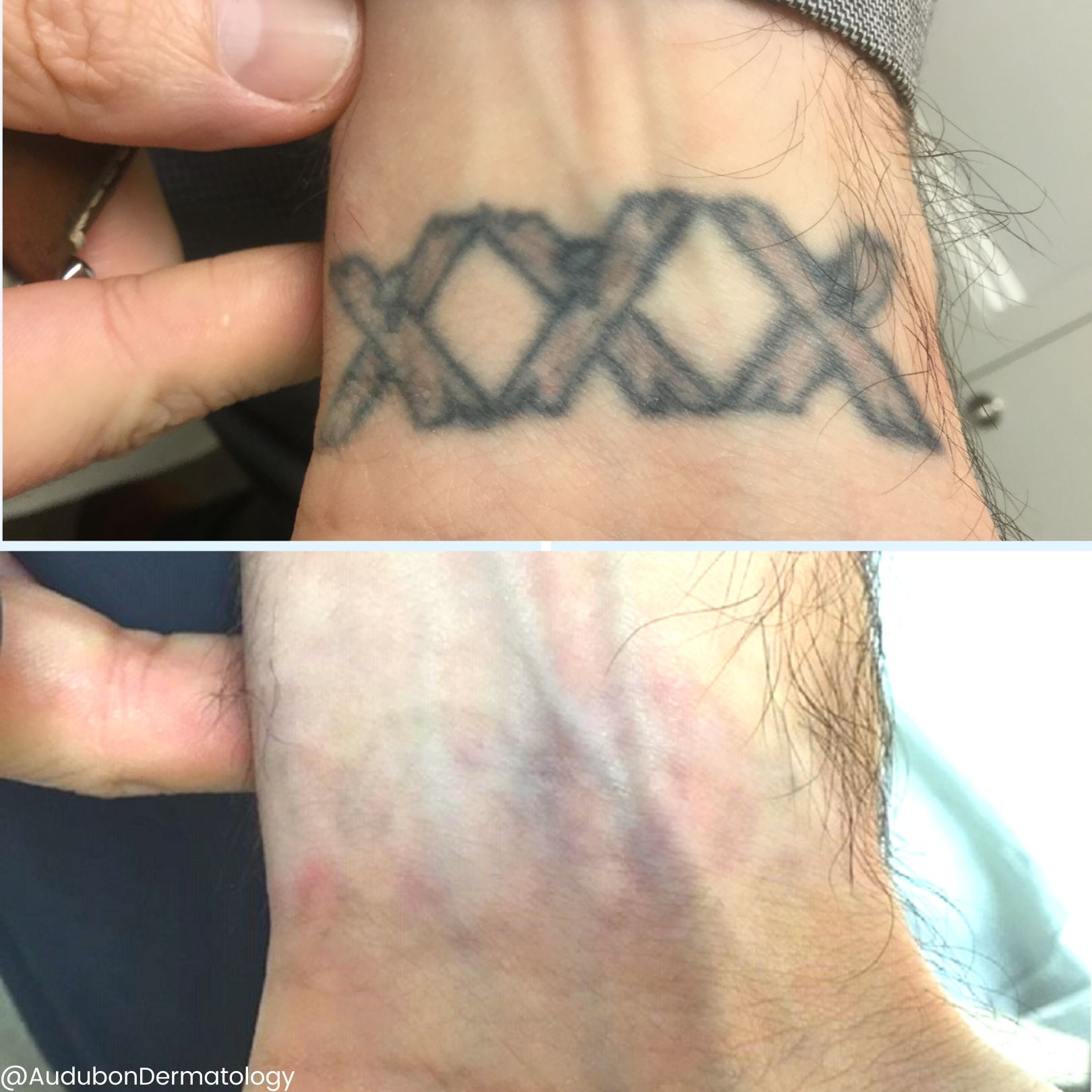 Tattoo Removal in New Orleans, LA | Audubon Dermatology Tattoo Removal in New Orleans, LA | Audubon Dermatology